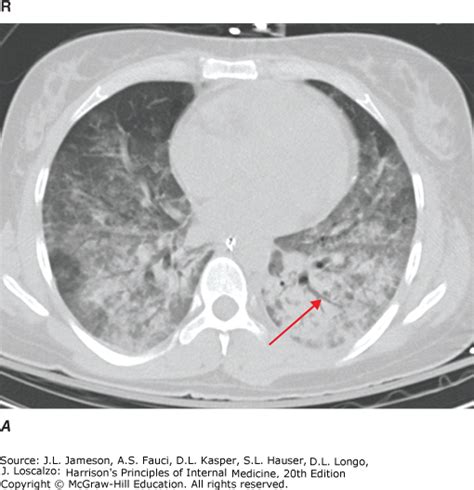 Atlas of Chest Imaging | Harrison's Principles of Internal Medicine, 20e | AccessMedicine ...