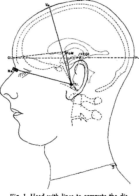 Figure 1 from Surface marking the foramen of Monro in ...