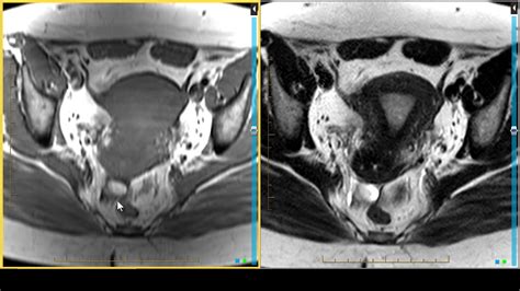 Pelvic Mri Procedure