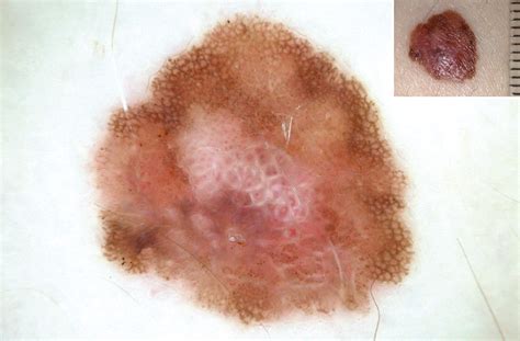 Dermoscopy of Melanocytic Neoplasms: Subpatterns of Melanoma—Degrees of Malignancy | Dermatology ...