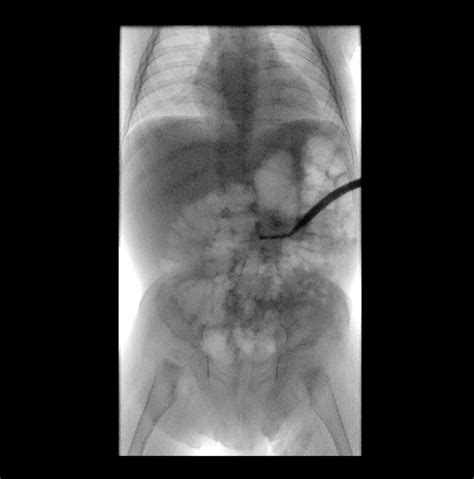 Gastrostomy Care