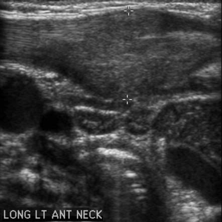 Fibromatosis colli | Radiology Case | Radiopaedia.org | Radiology, Case, Ultrasound