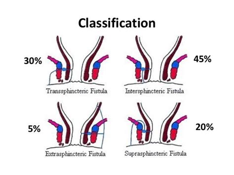 Tipos De Fistula