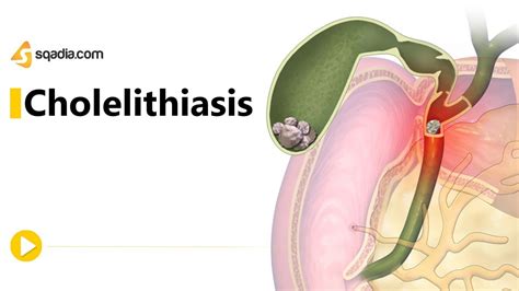 Cholelithiasis -II | Gastroenterology Medicine Animation | Medical V ...