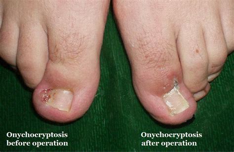 File:Ingrown Toenail, Onychocryptosis, Wedge Resection 01.JPG - Wikimedia Commons