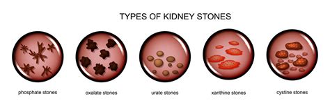 Kidney Stones: A Detailed Understanding - Medfin