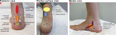 Heel Pain Diagnosis Chart - Best Picture Of Chart Anyimage.Org