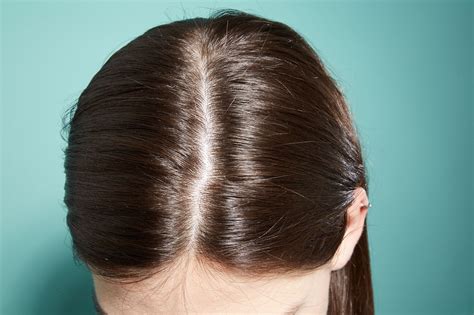 Dandruff and Dry Scalp Issues: A Dermatologist Tells All
