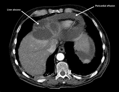 Pericardial tamponade due to ruptured pyogenic hepatic abscess - The British Journal of Cardiology