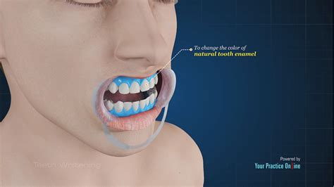 Teeth Whitening Video | Medical Video Library