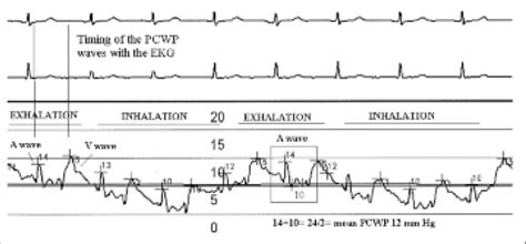 The proper timing to measure pulmonary capillary wedge pressure (PCWP ...