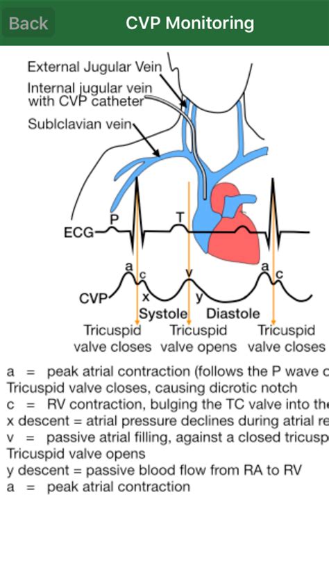 CVP monitoring | Icu nursing, Pediatric nursing, Emergency nursing