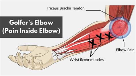 Golfer's Elbow (Root Cause & Fastest Way To Fix)