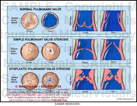 Medivisuals Pulmonary Valve Medical Illustration