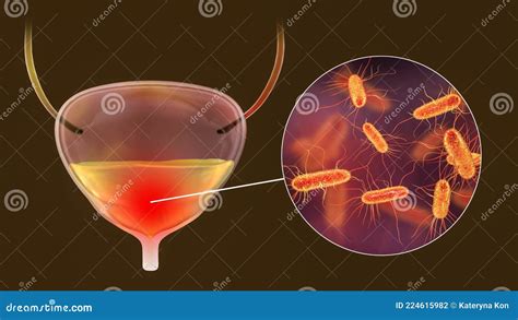 Cystitis, Infection Of Urinary Bladder Royalty-Free Cartoon | CartoonDealer.com #225998747