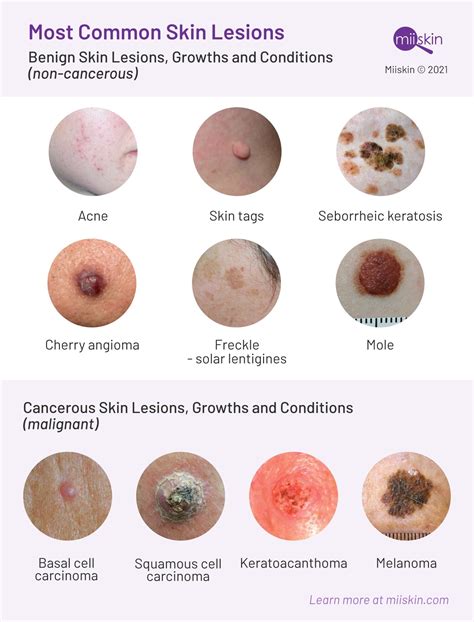 Tumor Skin Lesion