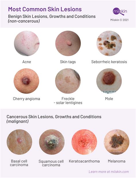 Types Skin Cancer Lesions