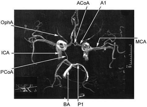 MRA Brain anatomy | Radiology Anatomy Images Arteries Anatomy, Brain Anatomy, Anatomy Images ...