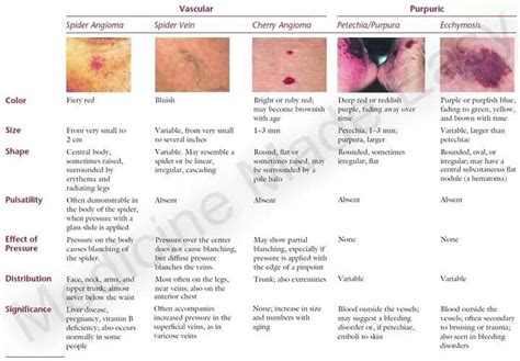 Pin by Милана Пузовић on Medical | Medical knowledge, Dermatology, Varicose vein remedy