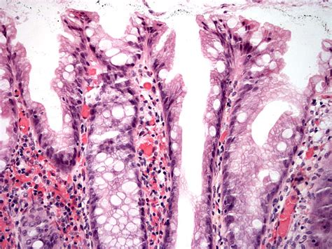 Pathology Outlines - Sessile serrated adenoma