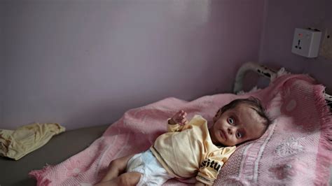 Hunger Stalks Children in Yemen as UN Cuts Aid Programs