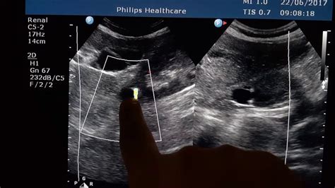 Milk Of Calcium Cyst Ultrasound