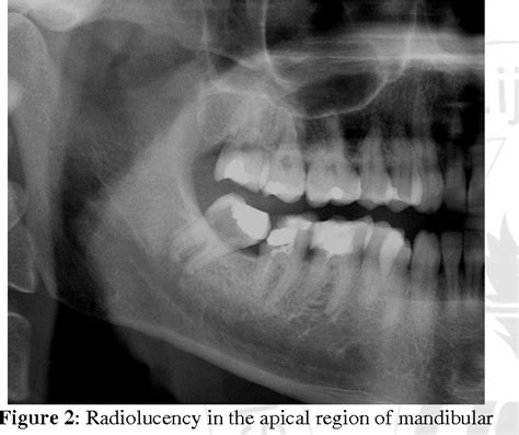 Figure 1 from Phlegmon in the Buccal, Temporal and Deep Temporal Space from Mandibular Wisdom ...