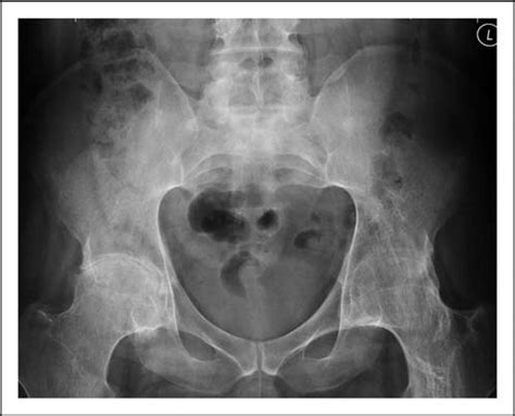 Plain radiography of a 45-year-old man with psoriatic arthritis ...