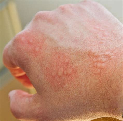 skin-allergy-contact-dermatitis - Fort Worth ENT & Sinus