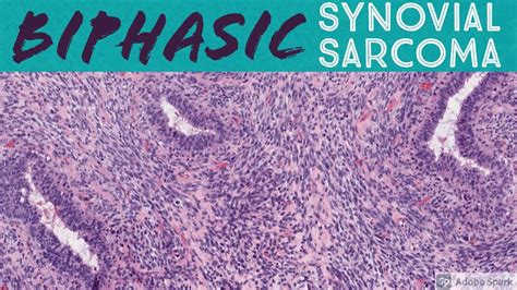 Biphasic Synovial Sarcoma: 5-Minute Pathology Pearls - YouTube