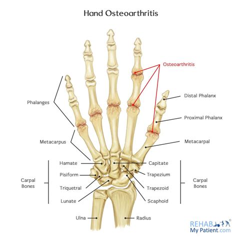 Hand Anatomy Arthritis