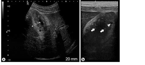 Ultrasound revealed gallbladder adenomyomatosis using different ...