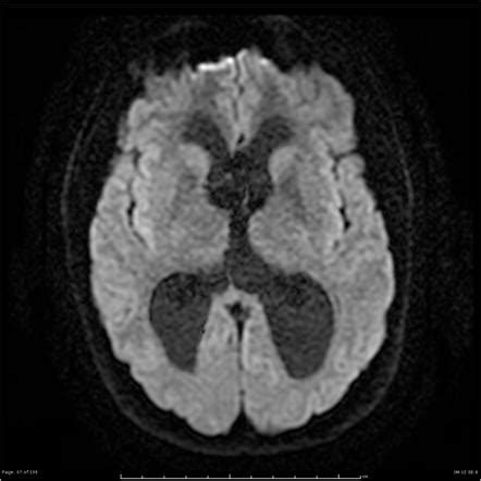 Tectal plate glioma | Image | Radiopaedia.org