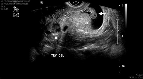 Ruptured Ectopic Pregnancy Ultrasound