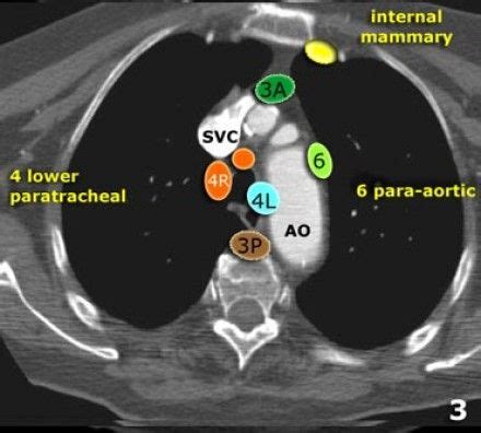 The Radiology Assistant : Mediastinum - Lymph Node Map in 2024 | Radiology imaging, Radiology ...