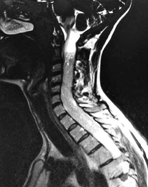 T1 weighted MRI with brain demonstrating the syringomyelia superior to ...