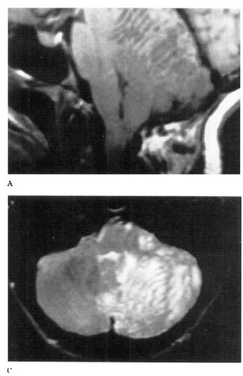 Figure 1 from MRI in Lhermitte-Duclos disease | Semantic Scholar