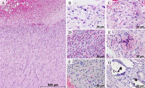 Morphological study of synovial changes in two-stage reconstructions of the infected hip and ...