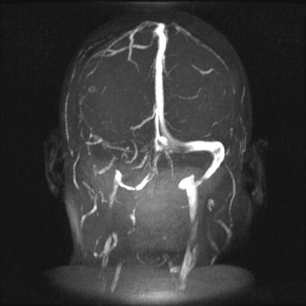 Transverse Sinus Mri