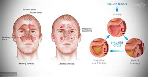 Common Cold Vs. Sinus Infection: How To Tell The Difference