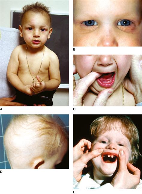 Ectodermal Dysplasia Syndrome