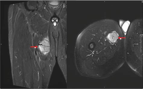 T2 MRI scan of the right thigh showing 4.5 cm mass (red arrows) within... | Download Scientific ...