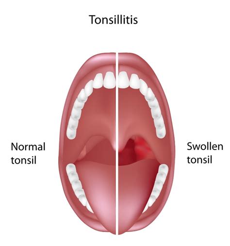 Tonsillitis - Otolaryngology Specialists of North Texas