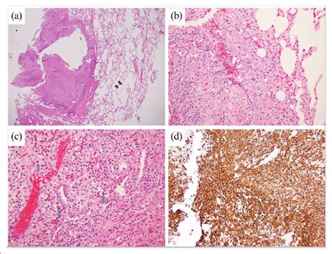 Histologic examination of lung parenchymal cells. (a) Subpleural and ...