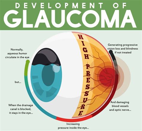 Glaucoma Awareness - Screen, Protect & Cure - Dr. John D. Bissell O.D.