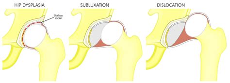 Hip Dislocation: Symptoms, Treatment, & Recovery - Heiden Orthopedics