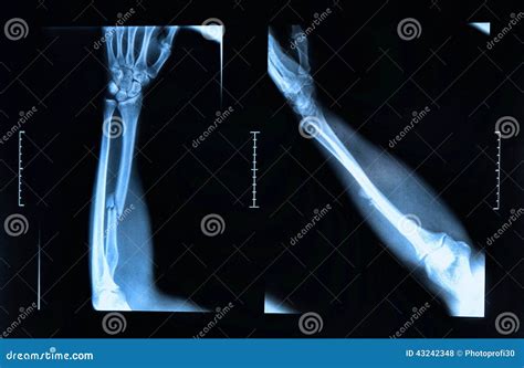 Arm fracture seen on x-ray stock photo. Image of crack - 43242348