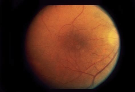 Cystoid Macular Edema (CME) - Retina Image Bank