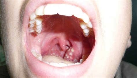 PPT - 8 Causes of White Spots On Tonsils You May Not Know PowerPoint Presentation - ID:7357905