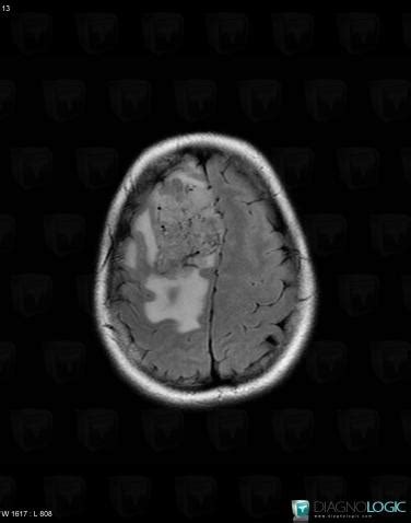 Radiology case : Hemangiopericytoma (MRI) - Diagnologic